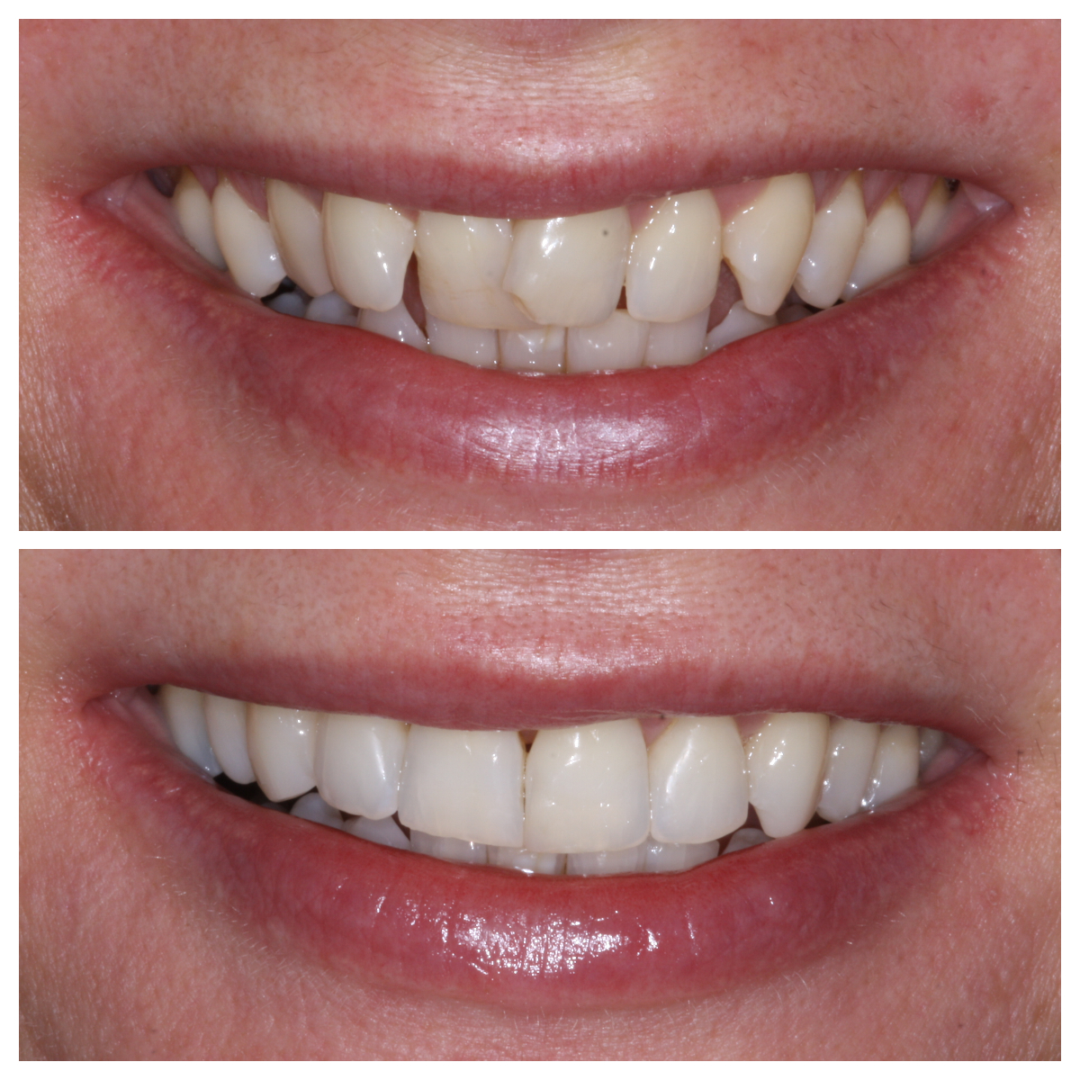 1. Tracy Bremner Anterior Smile - Deveron Dental Centre - Huntly